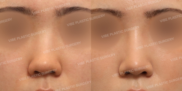 #낮은코 #복코 #비주교정