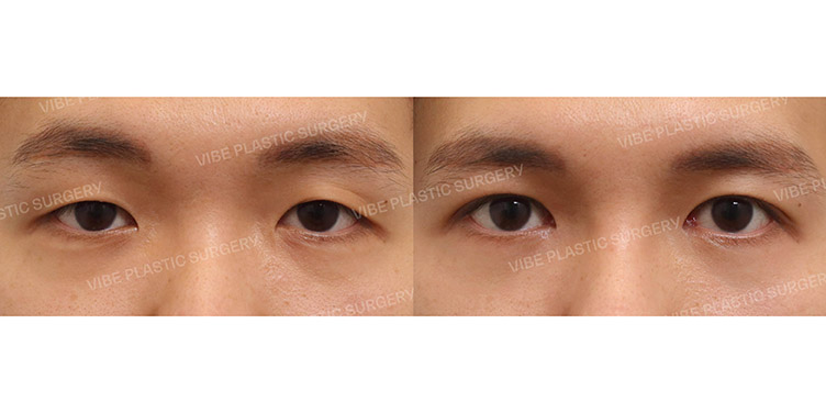 #비절개눈매교정 #앞트임