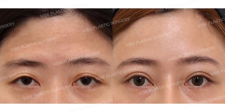 #부분절개눈매교정 #내시경이마거상