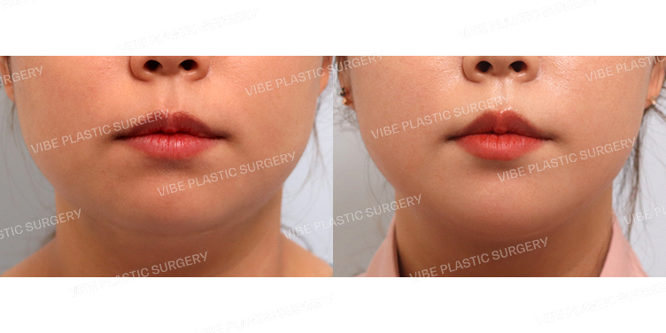 #초음파지방흡입(이중턱,턱라인)