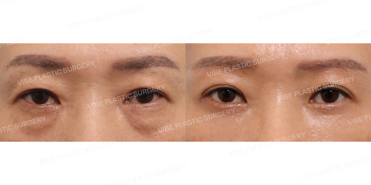 #눈썹밑거상술 #하안검