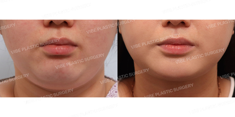 #초음파지방흡입(이중턱,턱라인)