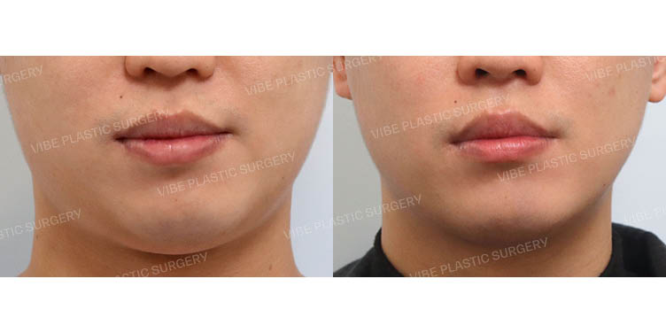 #초음파지방흡입(이중턱,턱라인) #심부볼지방제거 #슈링크 #침샘보톡스