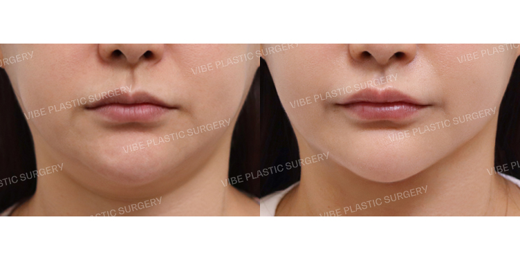 #초음파지방흡입(이중턱,턱라인) #턱끝필러