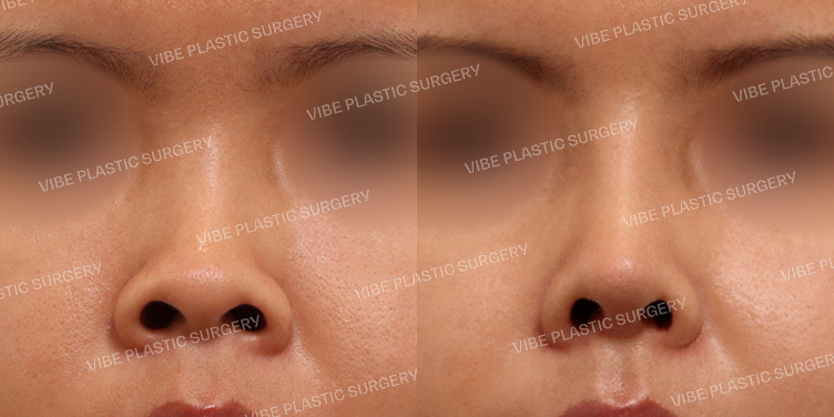 #짧은코 #복코 #콧볼축소