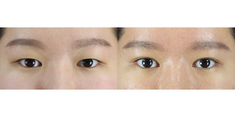 #부분절개눈매교정 #앞트임