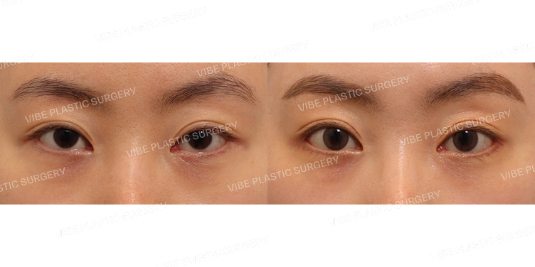 #눈재수술 #뒷트임 #밑트임