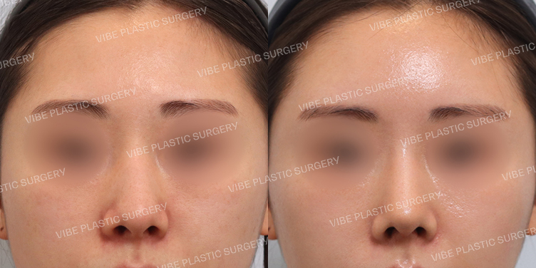 #이마지방이식 #무보형물 #매부리코 #휜코