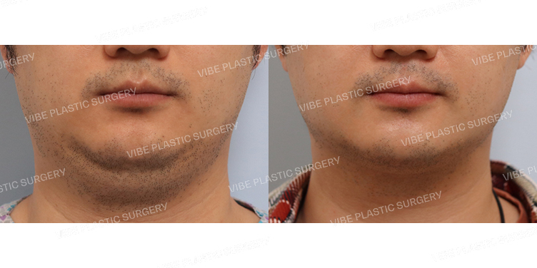 #초음파지방흡입(이중턱,턱라인)