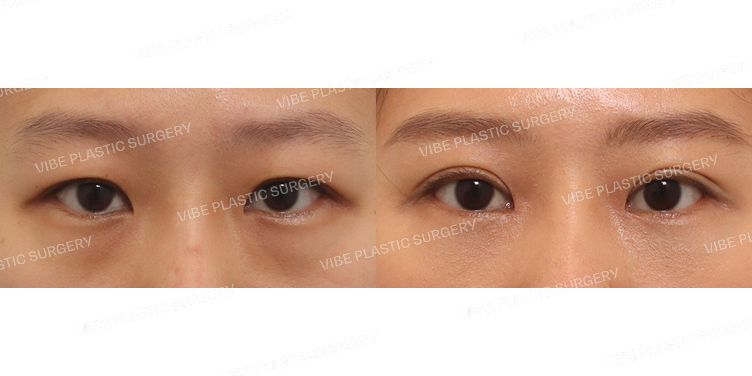 #절개눈매교정 #앞트임 #눈밑지방재배치