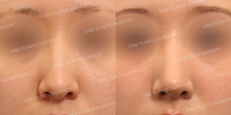 #무보형물 #매부리코 #긴코 #기능코