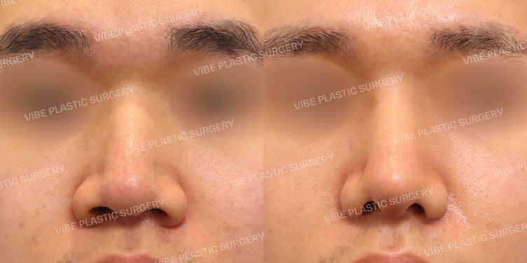 #무보형물 #매부리코 #복코