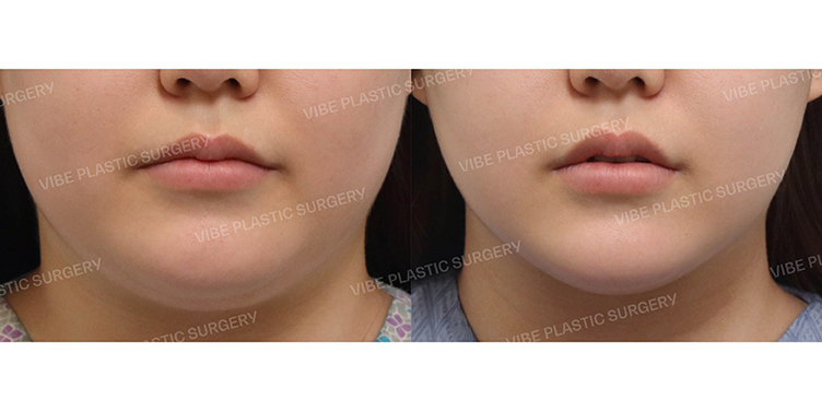 #초음파지방흡입(이중턱,턱라인,앞볼) #슈링크 #사각턱보톡스