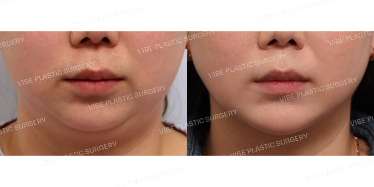 #초음파지방흡입(이중턱,턱라인) #턱끝필러