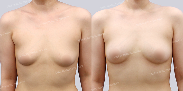#지방이식(가슴)