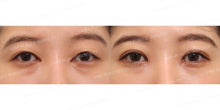 #앞트임복원 #절개쌍꺼풀(재수술)