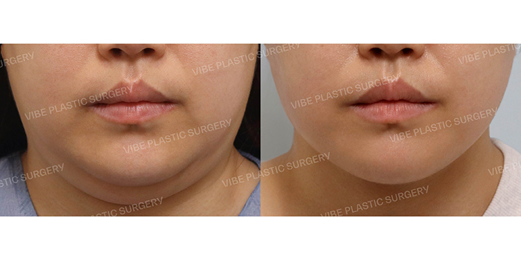 #초음파지방흡입(이중턱,턱라인) #슈링크