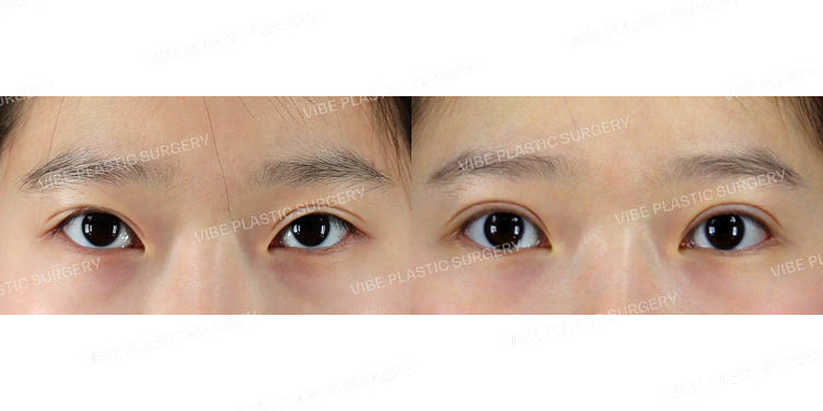 #눈매교정(재수술) #뒤트임