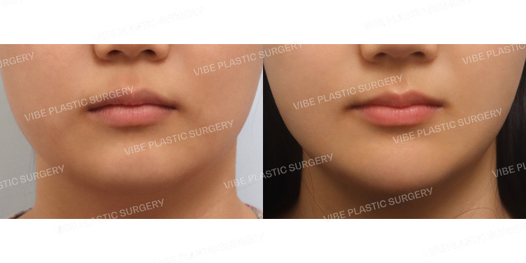 #초음파지방흡입(이중턱,턱라인) #턱끝지방이식