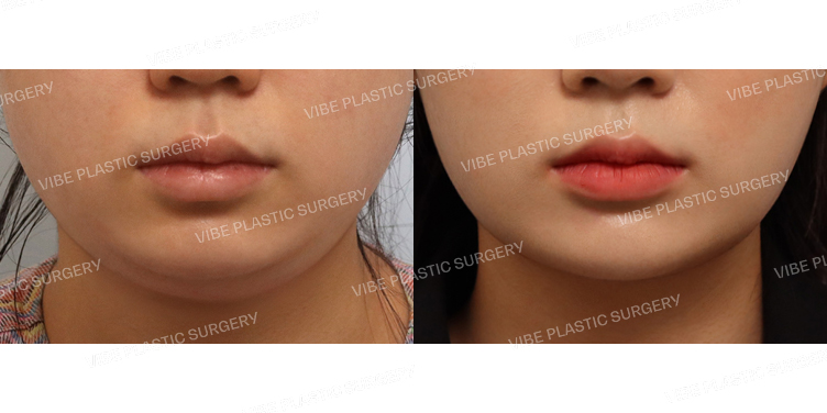 #초음파지방흡입(이중턱,턱라인)