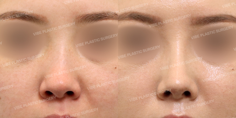 #콧대 #코끝 #매부리코 #기능코