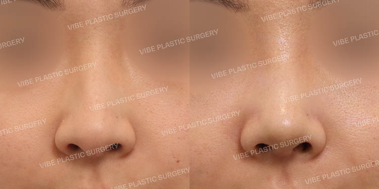 #무보형물 #매부리코 #긴코