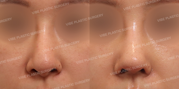 #비주교정 #복코 #휜코(재수술)