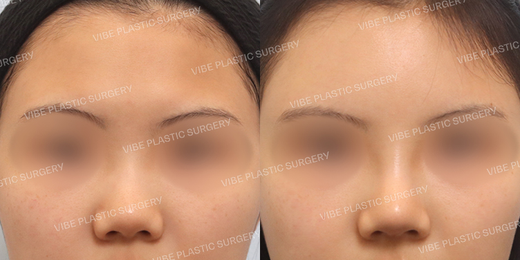 #낮은코 #이마지방이식