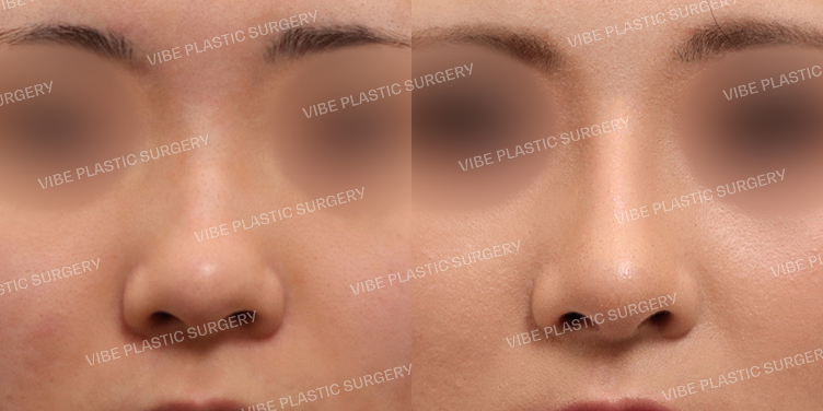 #매부리코 #복코