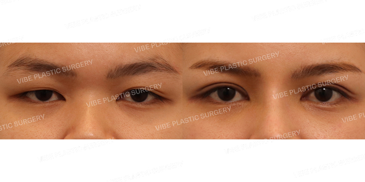 #절개눈매교정 #눈두덩이지방제거