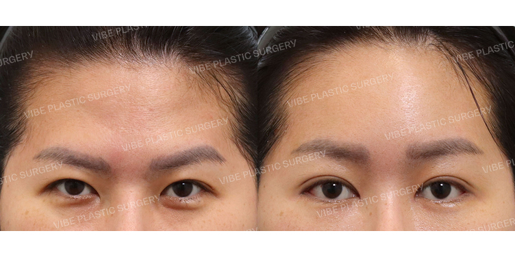 #절개눈매교정(재수술) #앞트임 #뒤밑트임 #내시경이마거상술