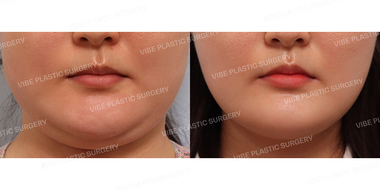 #초음파지방흡입(이중턱,턱라인) #사각턱보톡스