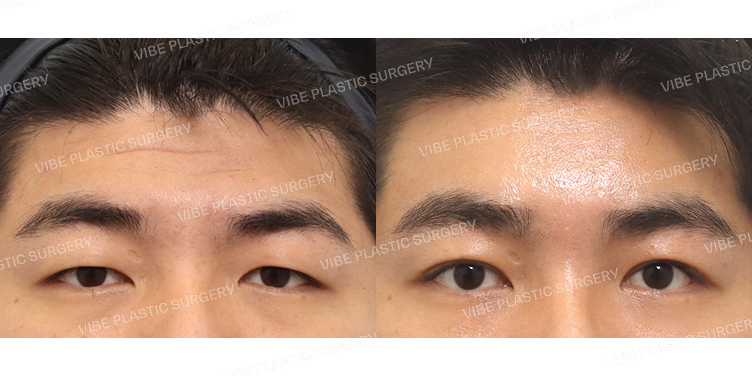 #내시경이마거상 #절개눈매교정