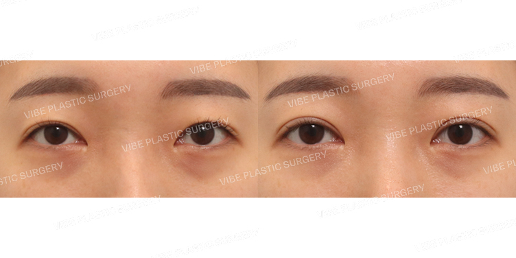 #절개눈매교정(재수술)