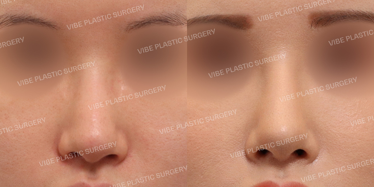 #코재수술 #긴코 #비주교정