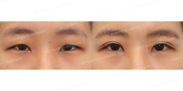 #비절개눈매교정 #앞트임