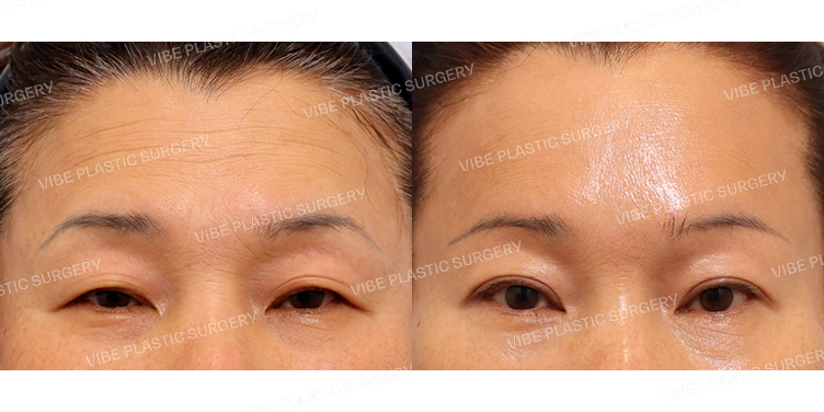 #자연유착 #내시경이마거상 #눈썹밑거상