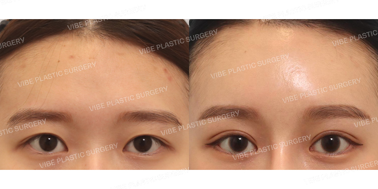 #절개쌍꺼풀(재수술) #뒤트임 #밑트임 #내시경이마거상