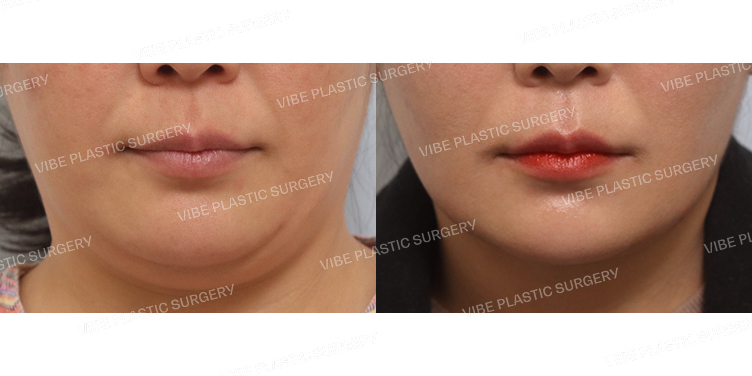 #초음파지방흡입 #실리프팅(이중턱,턱라인)