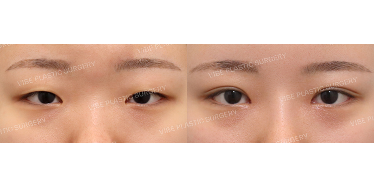 #부분절개눈매교정 #앞트임