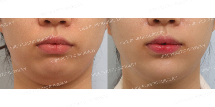 #초음파지방흡입(이중턱&턱라인) #턱끝필러 #턱보톡스