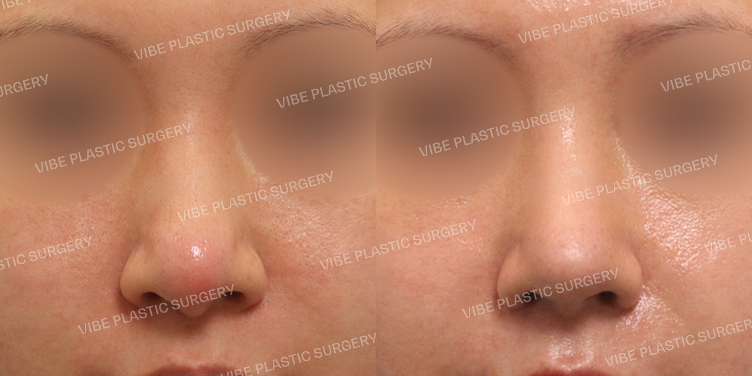 #복코(재수술) #무보형물