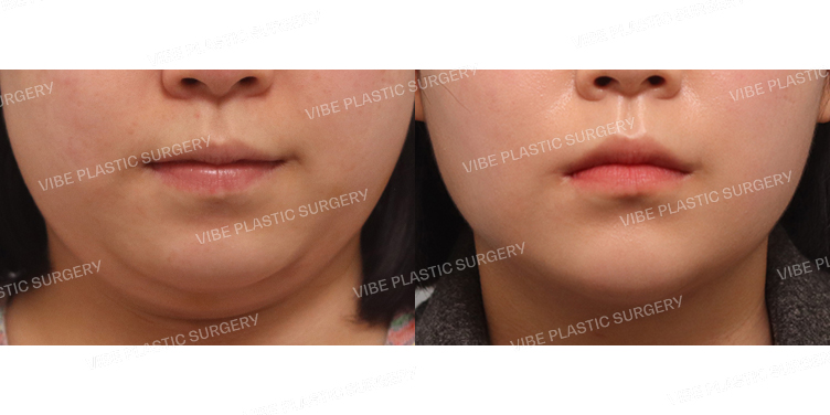 #초음파지방흡입(이중턱,턱라인)