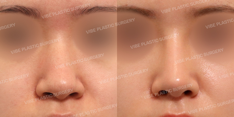 #기능코 #낮은코 #긴코 #복코