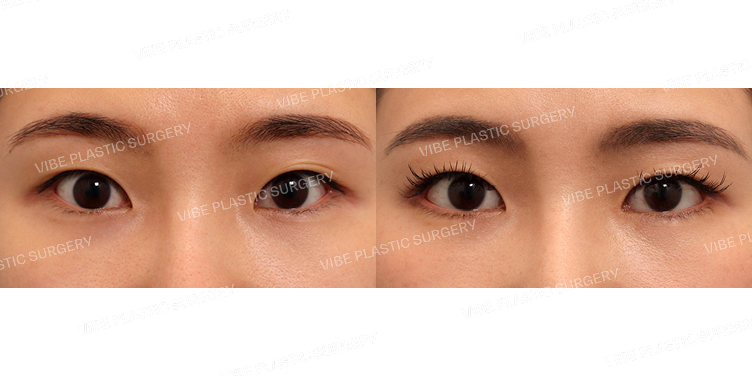 #뒤트임 #밑트임