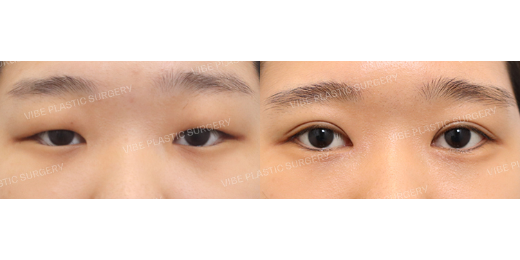 #절개눈매교정 #앞트임 #안검내반교정