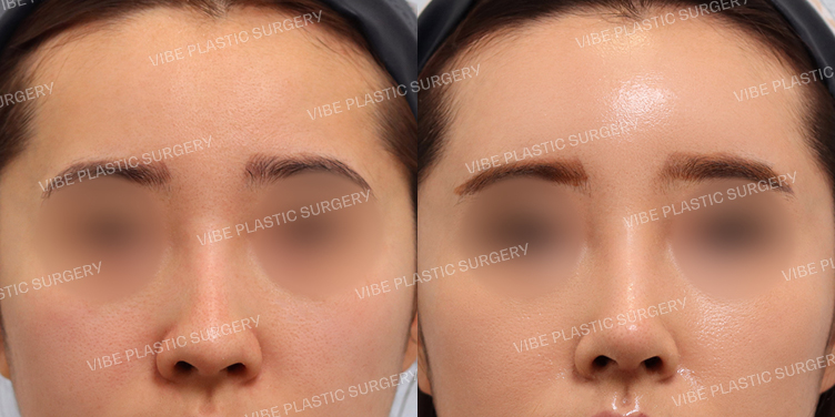 #무보형물 #매부리코 #긴코 #이마지방이식