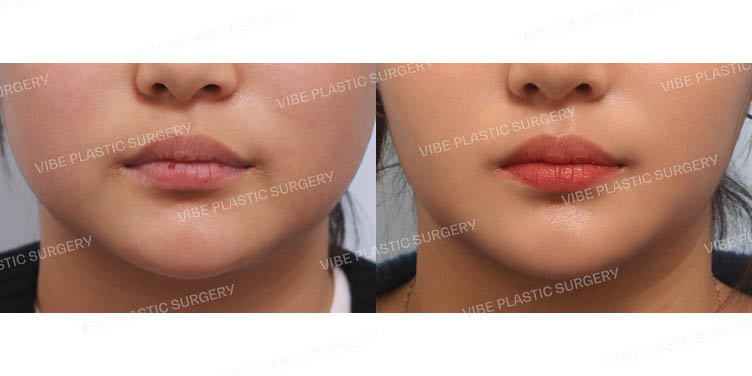 #이중턱지방흡입 #심부볼지방제거 #실리프팅