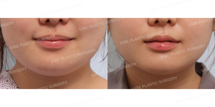 #초음파지방흡입(이중턱,턱라인)