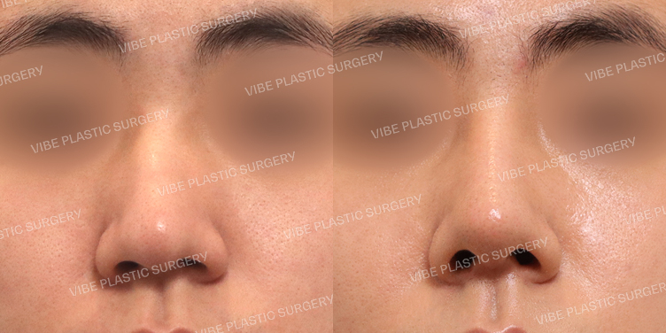 #휜코 #매부리코